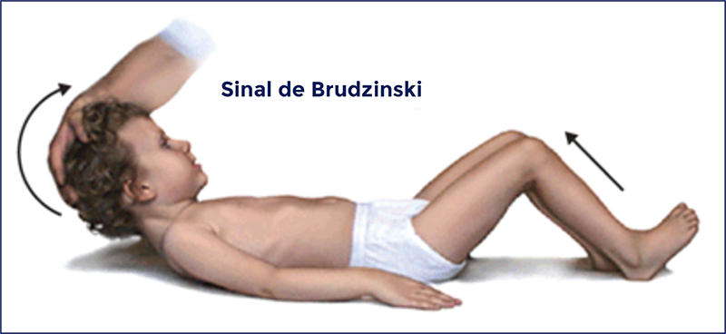 Sinal de Brudzinski