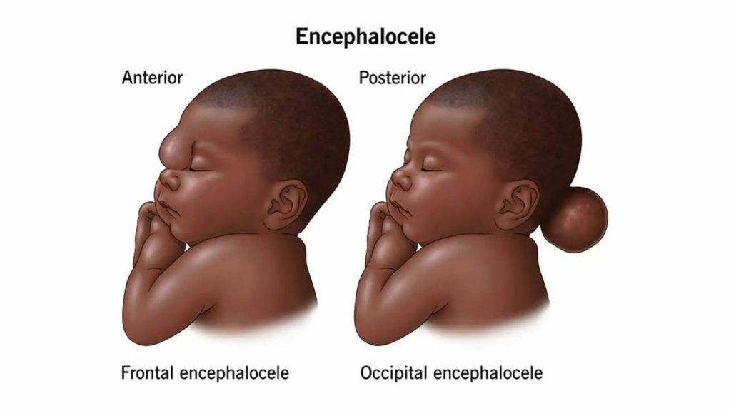 Encefalocele
