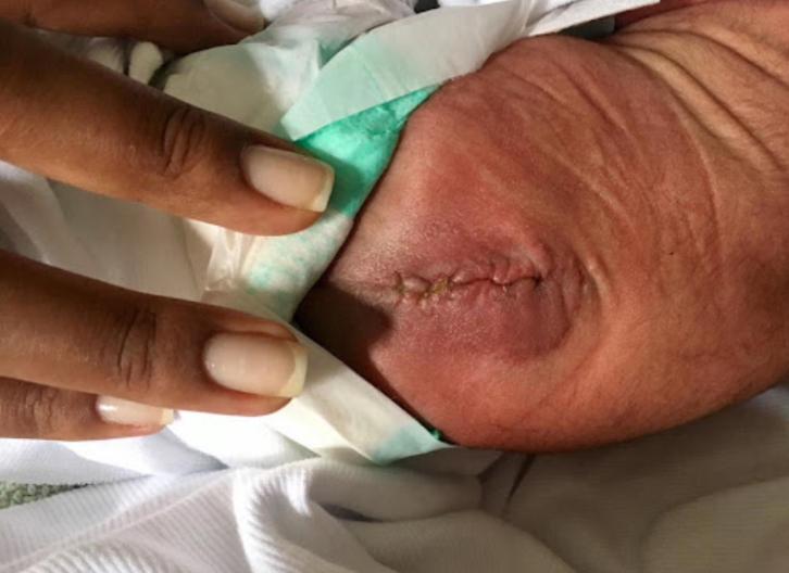 Cirurgia intrauterina fetal nos defeitos de fechamento do tubo neural