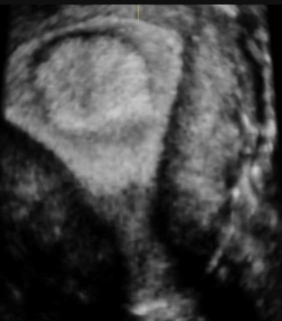 Ultrassonografia transvaginal com reconstrução 3D