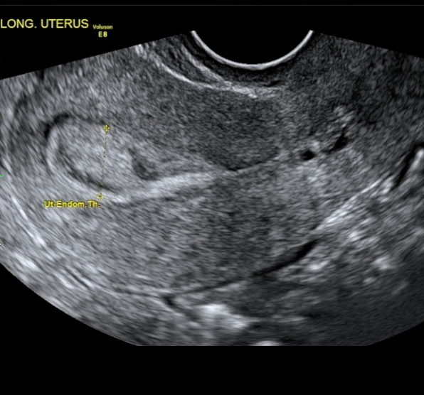 Ultrassonografia transvaginal modo B