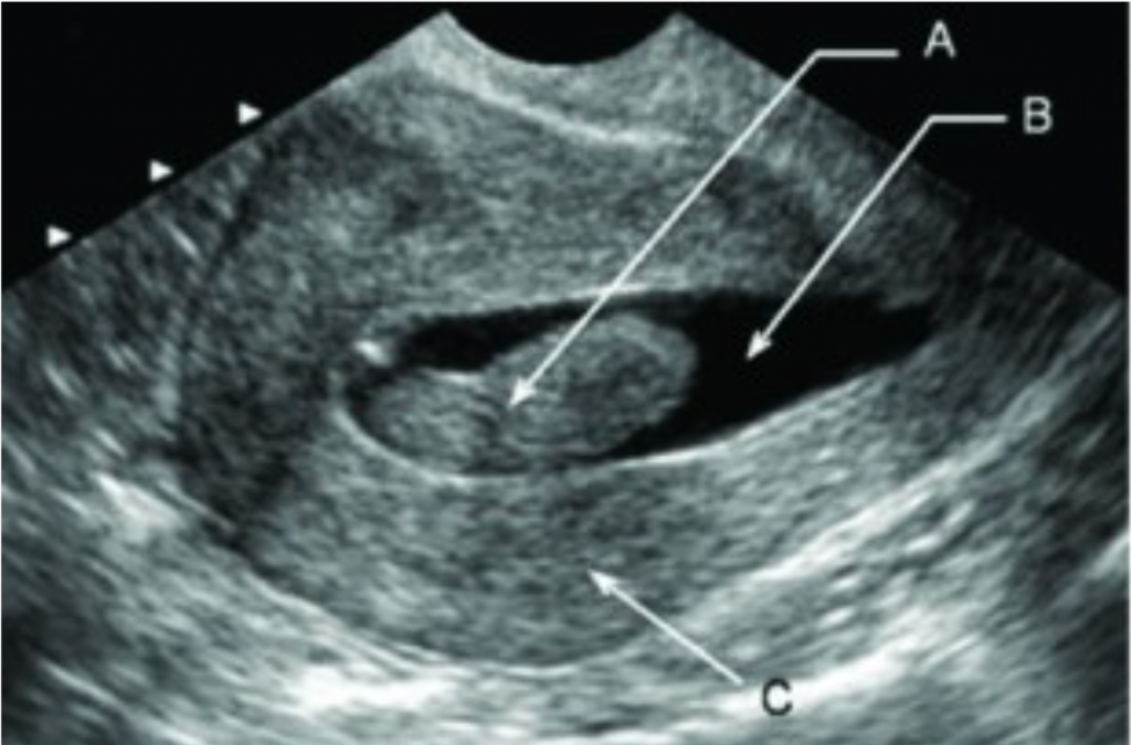 Ultrassonografia com infusão de soro (histerossonografia)