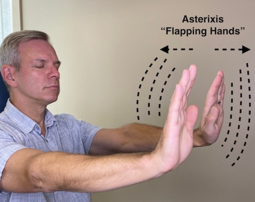 Imagem ilustrativa do sinal de Flapping