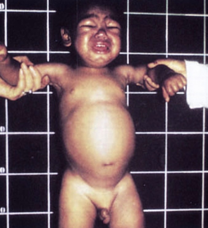 Kwashiorkor - apresentação clínica de desnutrição infantil