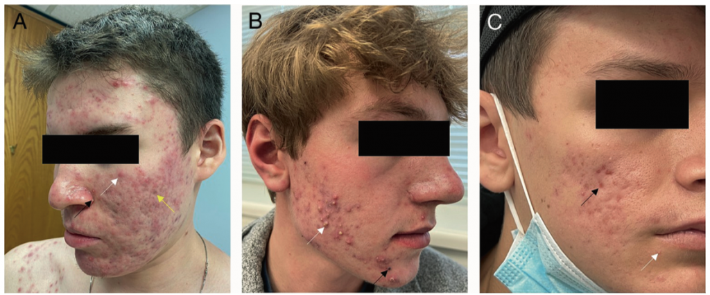 Acne, Rosácea e Dermatoses Inflamatórias: diagnósticos e manejo clínico