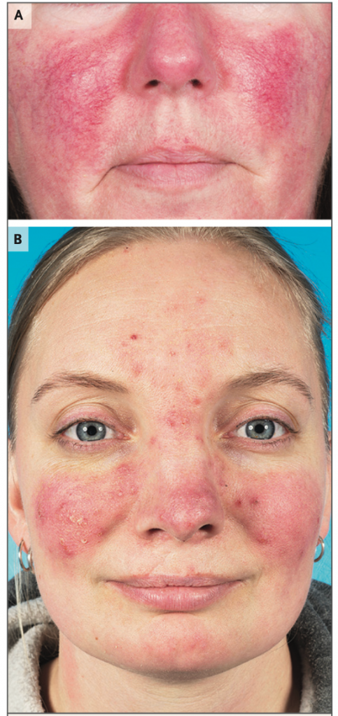 Acne, Rosácea e Dermatoses Inflamatórias: diagnósticos e manejo clínico